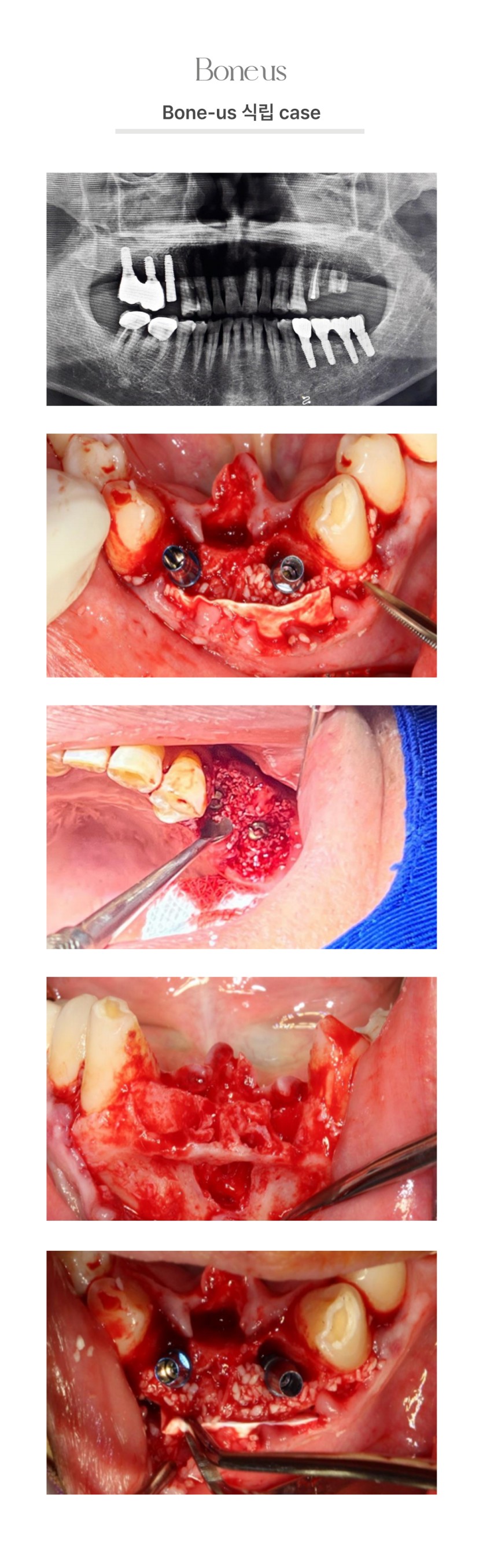 본어스 식립 케이스1