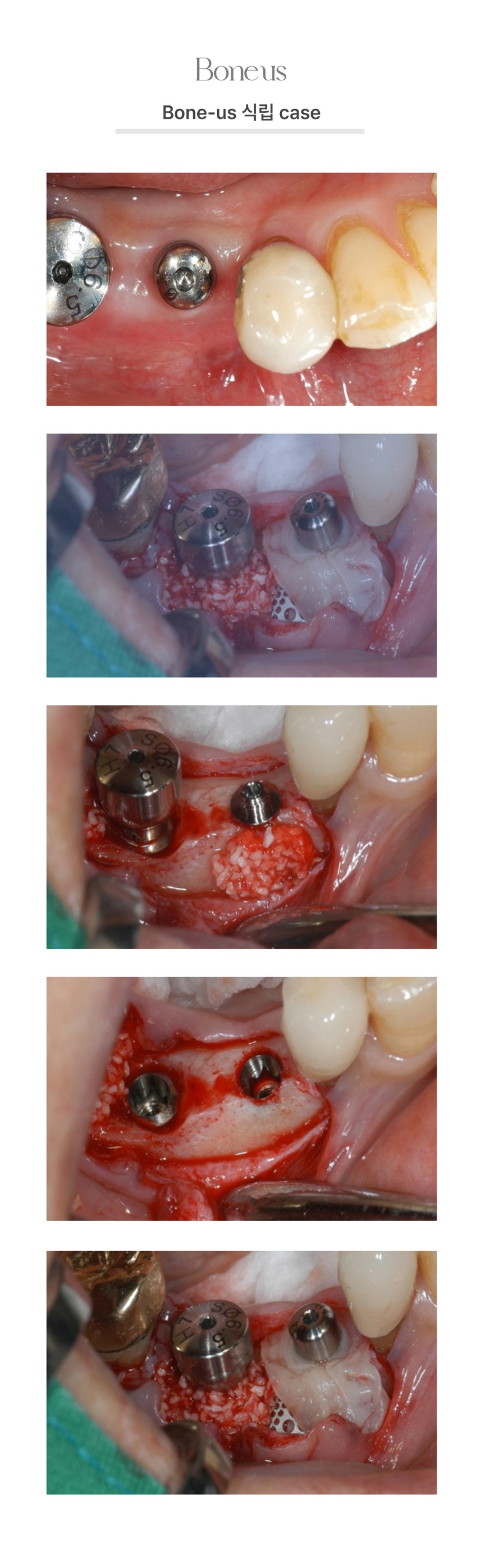 본어스 식립 케이스 2