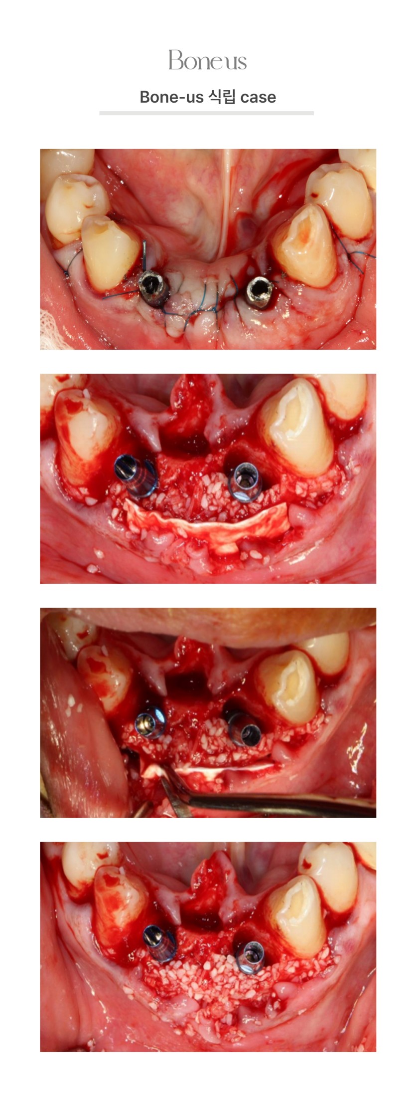 본어스 식립 케이스3