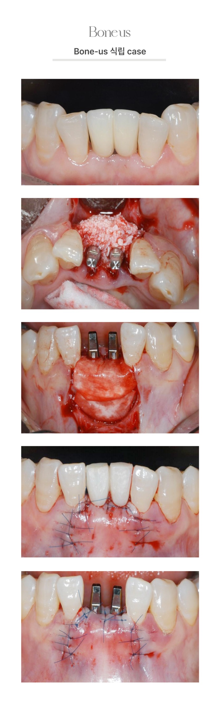 본어스 식립 케이스 6