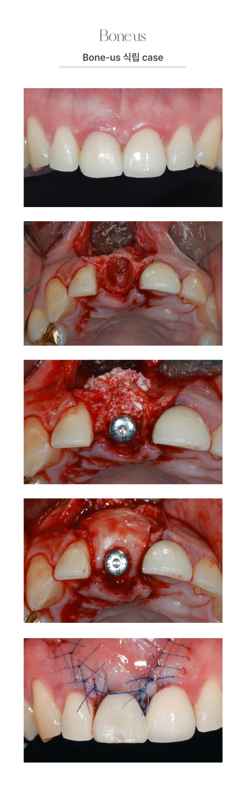 본어스 식립 케이스 8