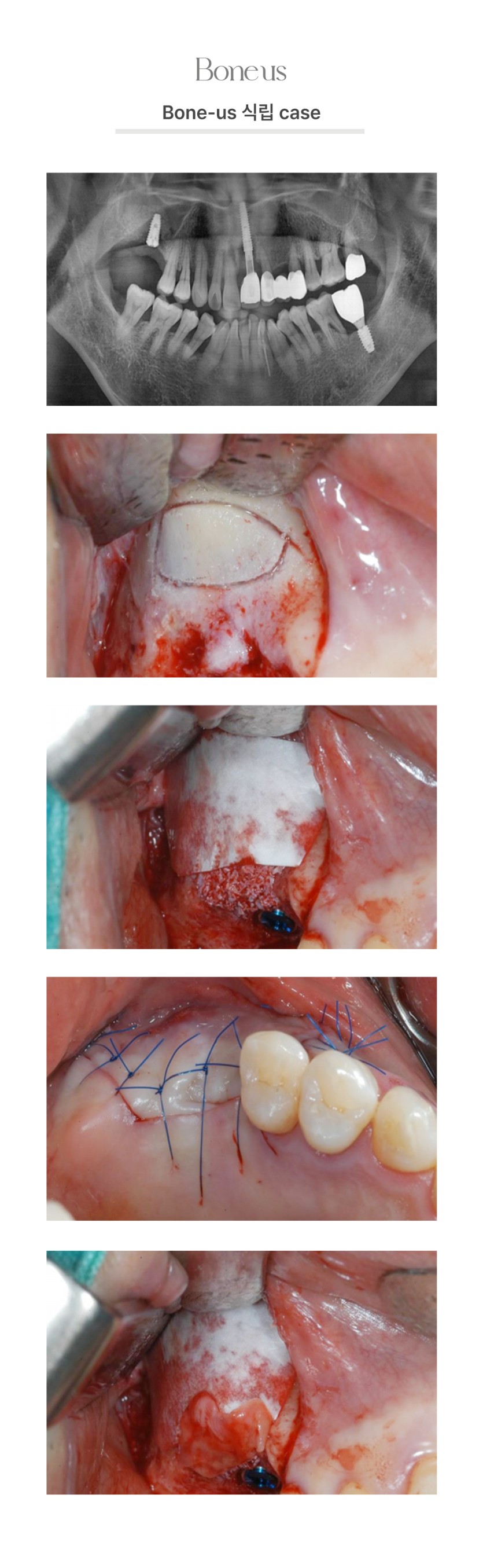 본어스 식립 케이스 9