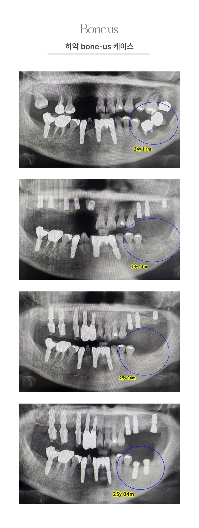 하악 본어스 케이스 1
