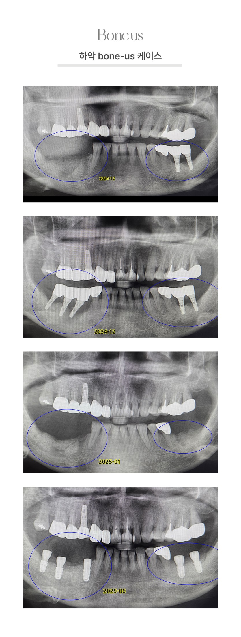 하악 본어스 케이스 3