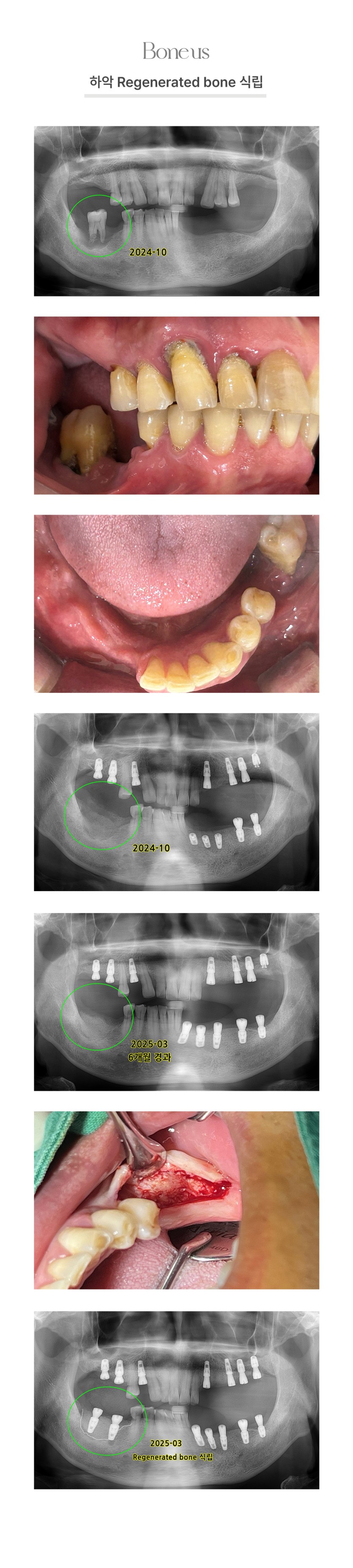 하악 Regenerated bone 식립 1
